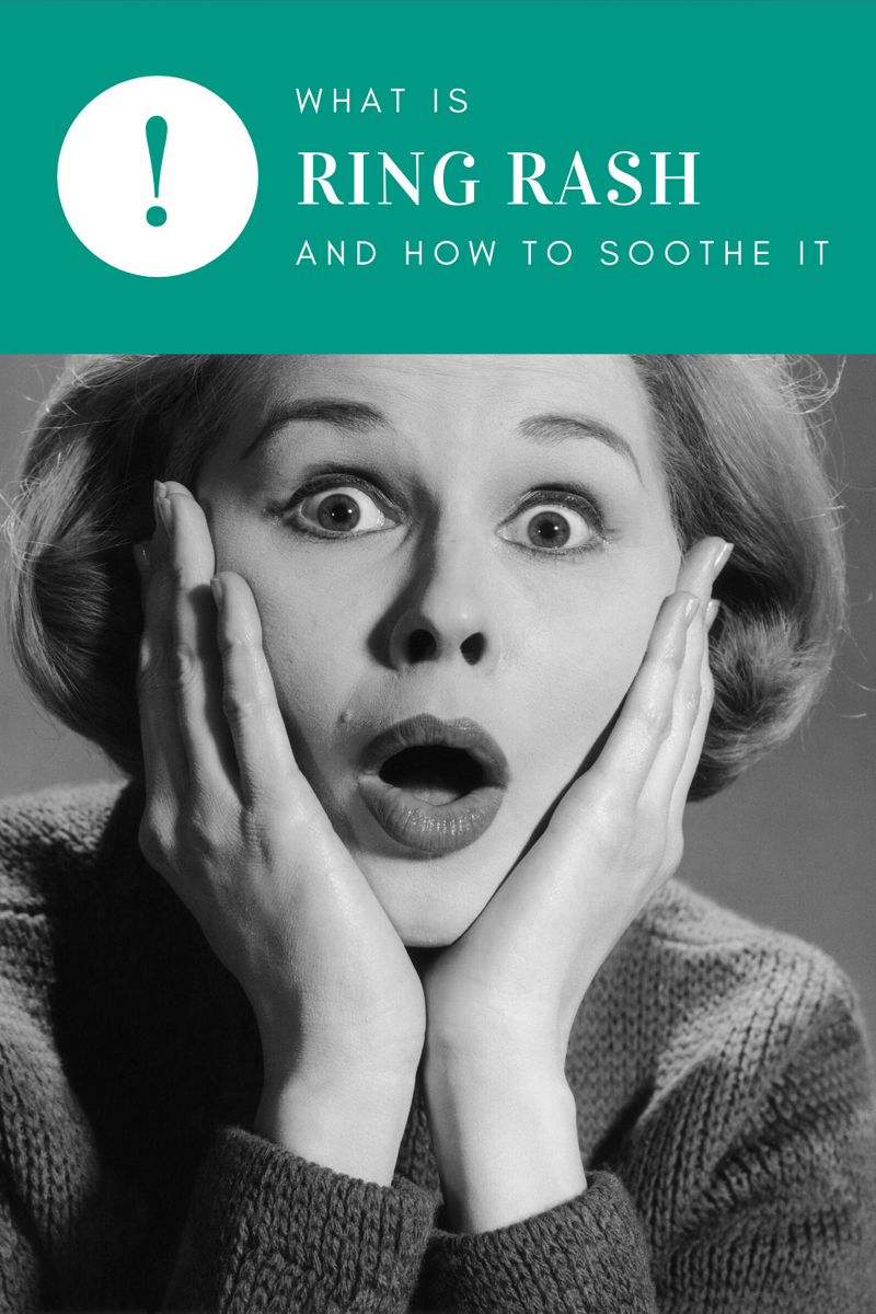 How to Get Rid of Wedding Ring Rash